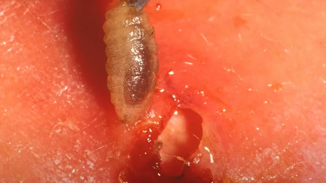Nechtěný suvenýr z dovolené. Muž si přivezl larvy zavrtané pod kůží. Stejný případ známe i z Česka
